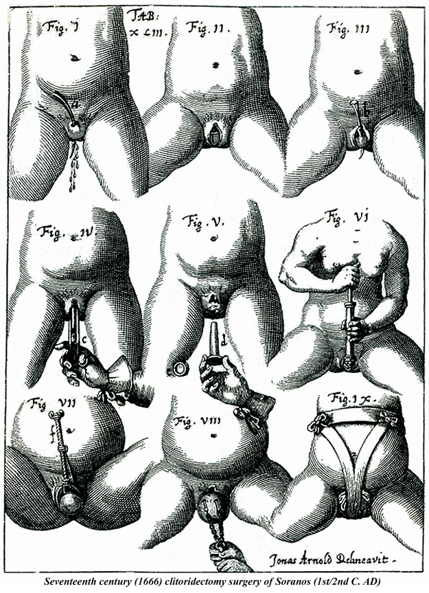 Seventeenth century clitoridectomy surgery 1666 of Soranos